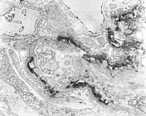 F,15y. | IgA nephropathy … subendothelial deposits F,15y. | IgA nephropathy … subendothelial deposits